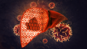 Análise Genética PNPLA3 e o Risco de Progressão da Esteatose Hepática: Um Novo Horizonte na Medicina Personalizada