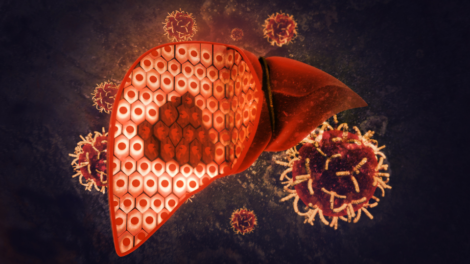 Análise Genética PNPLA3 e o Risco de Progressão da Esteatose Hepática: Um Novo Horizonte na Medicina Personalizada